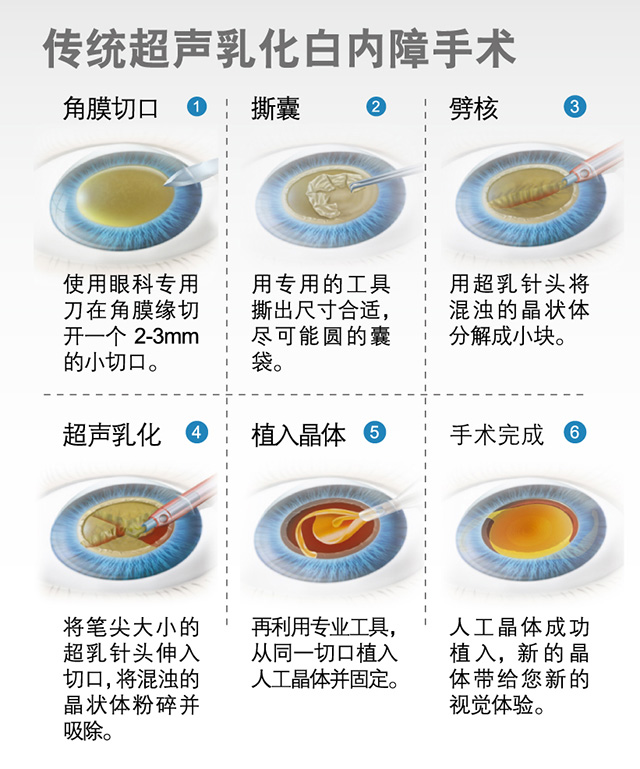 飛秒白內(nèi)障和傳統(tǒng)白內(nèi)障手術的區(qū)別